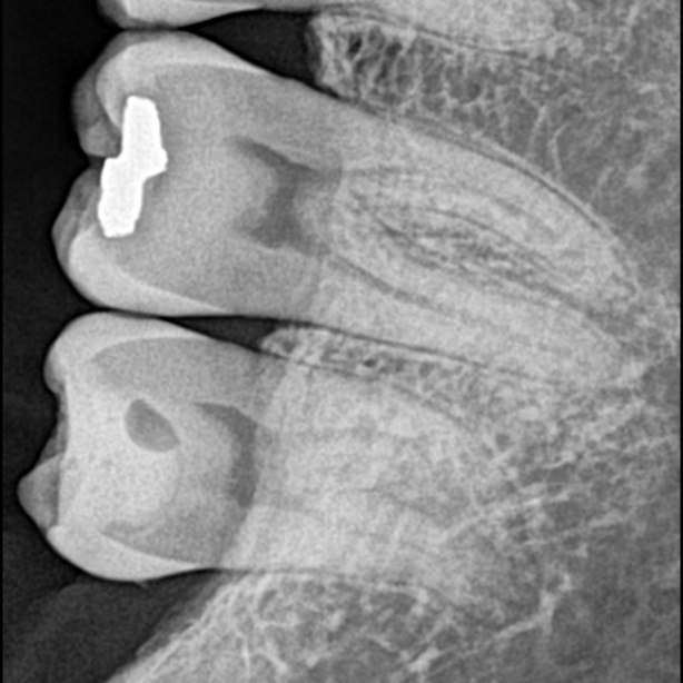 VX-30 dental röntgen görüntüsü örneği 1
