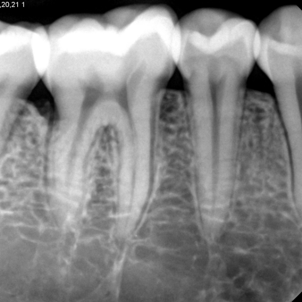 VX-30 dental röntgen görüntüsü örneği 2