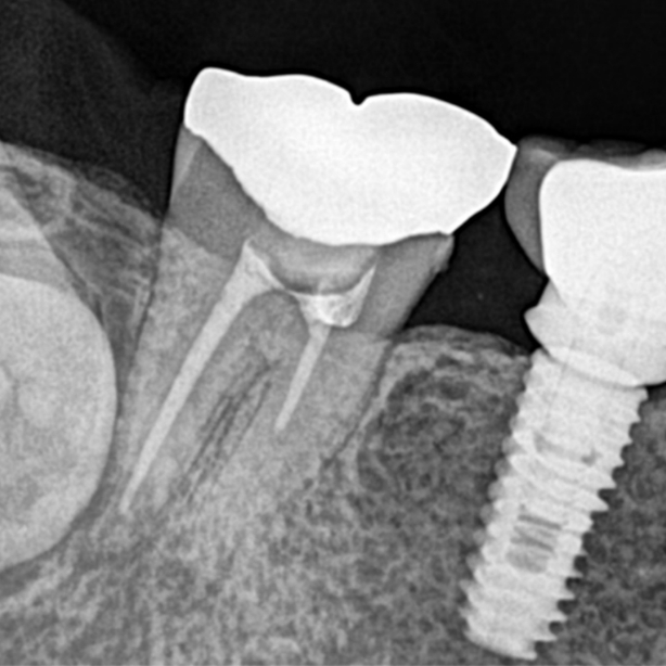 VX-30 dental röntgen görüntüsü örneği 3