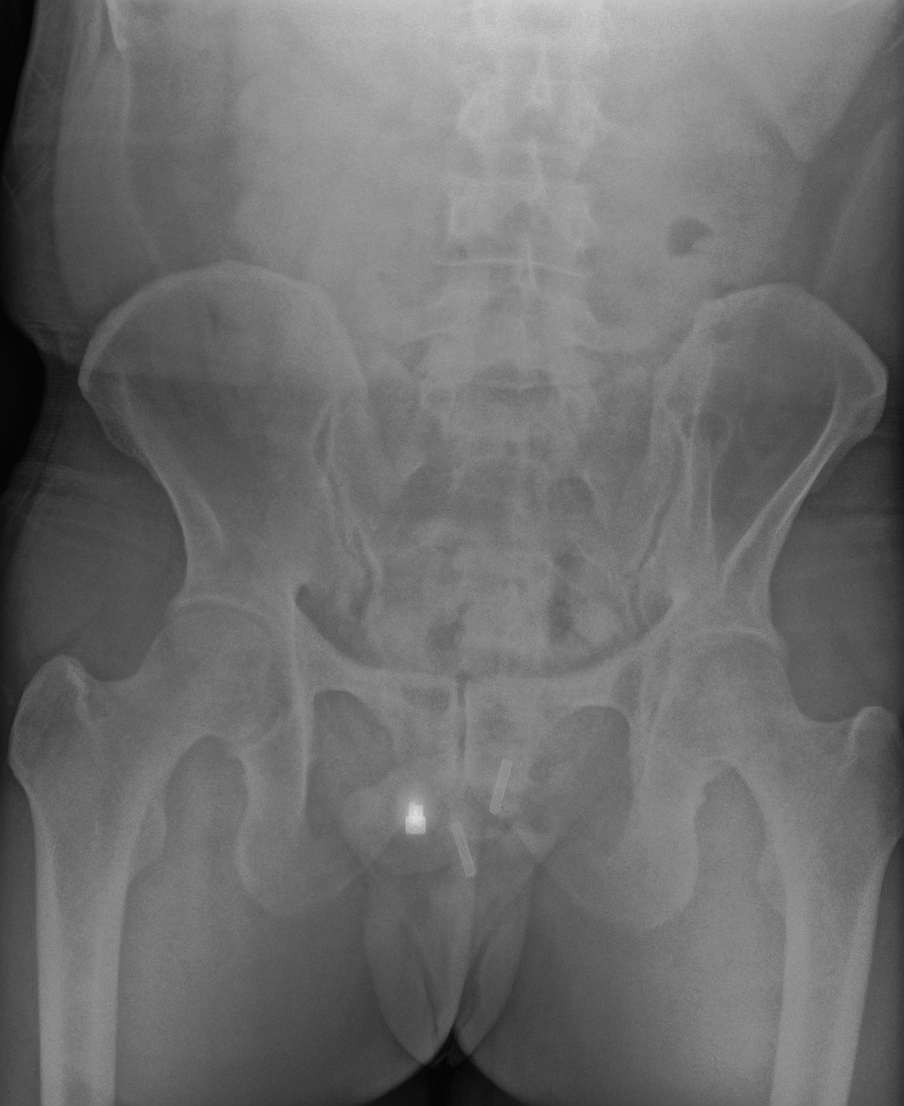 Pelvis AP röntgen görüntüsü